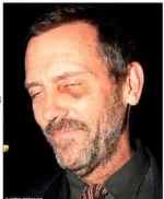 Hugh-Laurie-–-œil-au-beurre-noir.webp